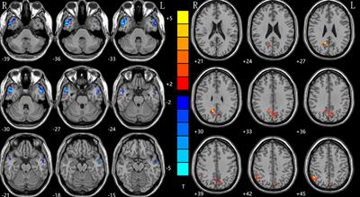 The Bilateral Precuneus as a Potential Neuroimaging Biomarker for Right Temporal Lobe Epilepsy: A Support Vector Machine Analysis